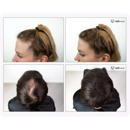 UVI Hair vlakna za kosu, DARK BROWN / Tamno smeđa (velika 27,5 g, do 50 nanosa) 