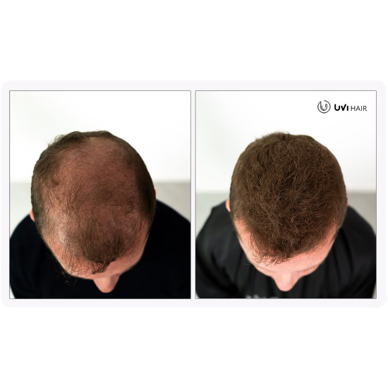 UVI Hair lasna vlakna, LIGHT BROWN / Svijetlo smeđa (veliki 27.5 g, do 50 nanosov) 