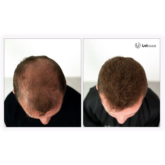 UVI Hair vlakna za kosu, DARK BROWN / Tamno smeđa (velika 27,5 g, do 50 nanosa) 